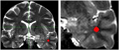 Histopathological Correlations of Qualitative and Quantitative Temporopolar MRI Analyses in Patients With Hippocampal Sclerosis